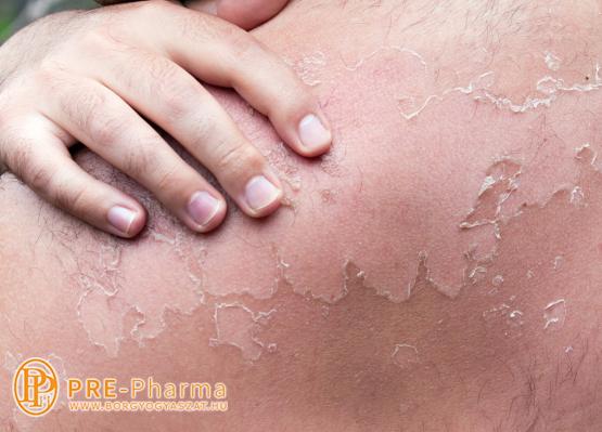 Napégés után a bőr hámlása